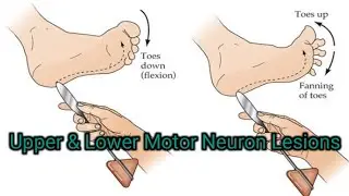 Upper and Lower Motor Neuron Lesions
