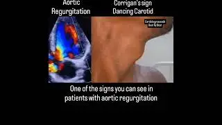 #aortic regurgitation ##dancing carotid @Sudarshanlipane177 😷🩺🙏⛑️💊🛣️
