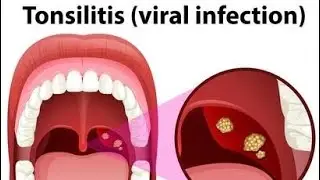 Tonsils|| Tonsillitis || viral infections || throat problems||  ENT || respiratory|| winter care || 