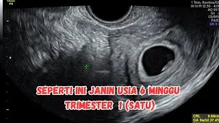 USG KEHAMILAN | PERKEMBANGAN JANIN USIA 6 MINGGU | TRIMESTER 1 (SATU)