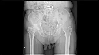 M/81, 1 year after dual mobility total hip arthroplasty for Legg-Calve-Perthes (LCP) disease (gait)