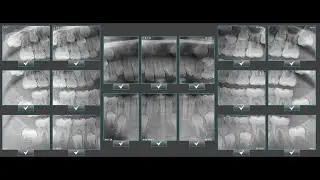 X-era Dental Cone Beam Machine FMX Clipping Video 2 0