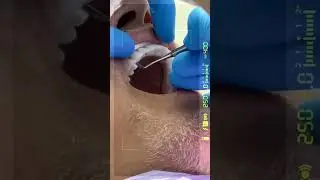💥ЮВЕЛИРНАЯ работа! All on 6. Зубы из ЦИРКОНИЯ😍🤩👄 #имплантация_зубов  #allon6dentalimplants