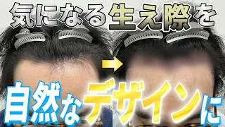 「おでこを狭くするのは率直に言って可能？」｜1400株の植毛当日～翌日の経過に密着