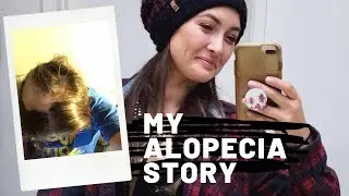 My Alopecia Story