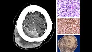 LINFOMA DURAL PRIMARIO | LINFOMA B DIFUSO DE CEL. GRANDES | NEUROPATOLOGÍA | IMSS | UNAM | SECIHTI