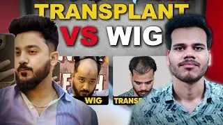 Hair Wig vs Hair Transplant: Kya Hai Behtar? 🤔 | Full Comparison in Hindi