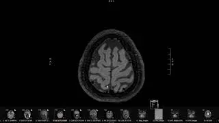 MRI of Severe Headache