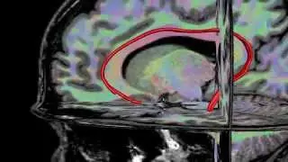 Diffusion MRI combined with T1 weighted MRI