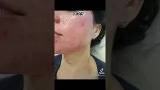 Acne scar treatment. Microneedling+PRP.This is after 3 sessions. Follow us @nuvueu 2039184113