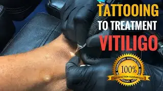 Medical pigmented tattooing to treat vitiligo white patches | 100% results