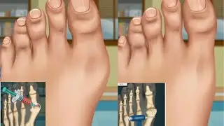 ASMR foot finger surgery successful patent happy #asmr #surgery #doctor #treatment #mrnajeebideas