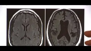 Life after sports: Examining brain health in retired athletes