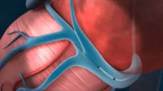 QuickSite LV Lead