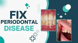 How to Reverse and Fix Periodontal Disease: 6 Effective Ways