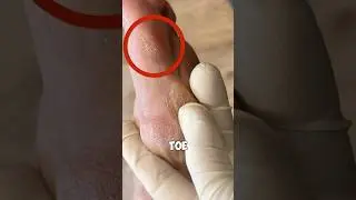 Что такое мозоль?!🤯😳 #шорты