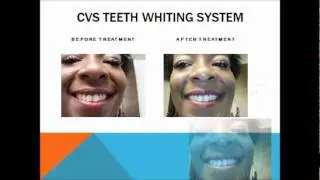 Tam-Tam's Glam Slam Review- CVS Haul for 1 Hour Teeth Whiting Treatment