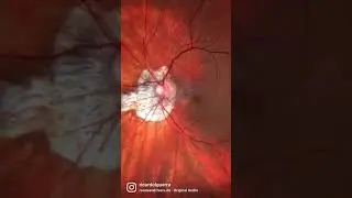 I see Pathologic Myopia.. all the time! 👻 #retina #oftalmo #ophthalmology #oftalmologia #oftalmolog