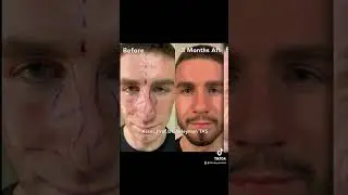 Male Revision Rhinoplasty Before & 3 Months After