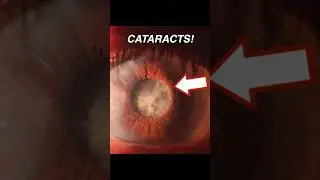 Врач объясняет: как образуется катаракта! 👁️☁️