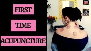 Does Acupuncture Hurt? (Honest Review: MY FIRST TIME!)