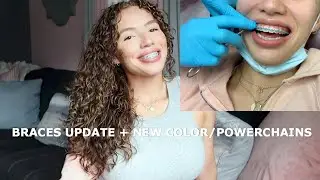 BRACES UPDATE♡ CLOSING MY GAP + NEW COLOR???