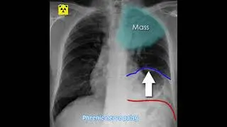 Chest X-ray Abnormalities 03