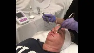 Cotton Tip Probe Treatment | MyoLift 600