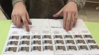 Вылечили пациента с  циррозом печени.Результат FibroScan снизился на 86 к