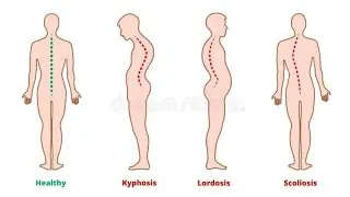 Common Postural Deformities (Spinal Curvature)