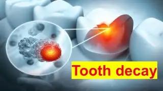 Tooth decay by S.P sir || Shivam Pandey 
