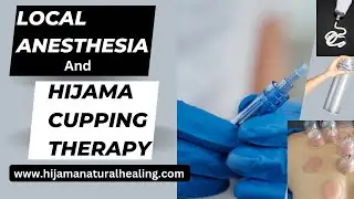 Is It Safe To Use Local Anesthesia Before Hijama Cupping Therapy? |Hijama Natural Healing
