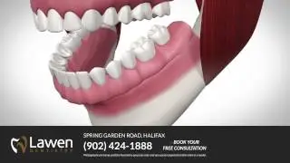 Secure your Dentures with Dental Implants at Lawen Dentistry