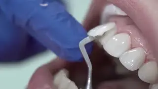 dental veneers procedure #shorts