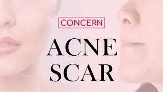 Top Acne Scar Treatment in India | Real Patient Review | Sakhiya Skin Clinic
