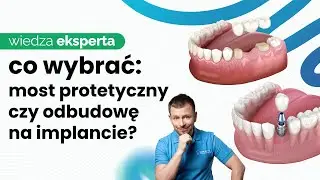 MOST NA IMPLANTACH A MOST NA ZĘBACH NATURALNYCH - KLUCZOWE RÓŻNICE