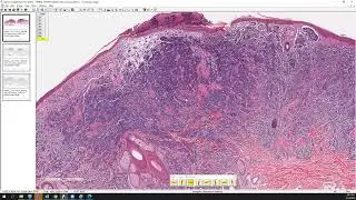 Merkel cell carcinoma