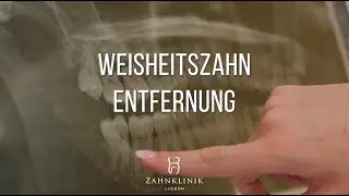 Weisheitszahn ziehen lassen - So l&auml;uft die Weisheitszahnentfernung ab!