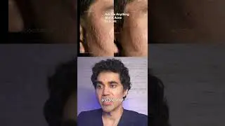 Do PRF Injections improve acne scars?