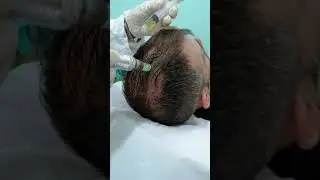 Tratamiento PRP Capilar