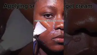 cream for fungal acne #skincare