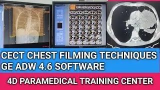 CECT CHEST FILMING TECHNIQUES IN GE ADW 4.6 SOFTWARE #ge #cect #chest #radiology