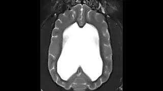 Risk factors, treatment, and outcome associated with ventriculoperitoneal shunting in dogs and cats
