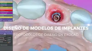 DISEÑO DE MODELOS PARA IMPLANTES - MODEL CREATOR EXOCAD