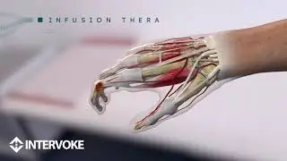 Infusion Therapy Rheumatoid Arthritis Demo