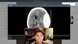 💀 Brain Bleed Simulation (Epidural Hematoma Explained) | Emergency Medicine Case Review
