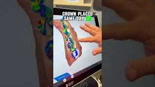 Same-Day Dental Crowns Explained in 15 Seconds | Neighborhood Dental 👑🦷