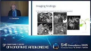 Imaging for diagnosis & management of Cholangiocarcinoma | Ε. Chartabilas