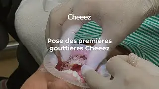 Aligneurs Cheeez : Pose des premi&egrave;res goutti&egrave;res d'alignement