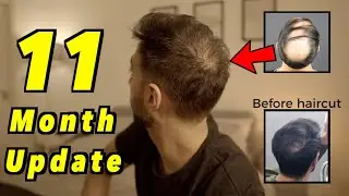 11 Month 2nd Hair Transplant Update | 4000 GRAFTS FUE | I MESSED UP (bad haircut)